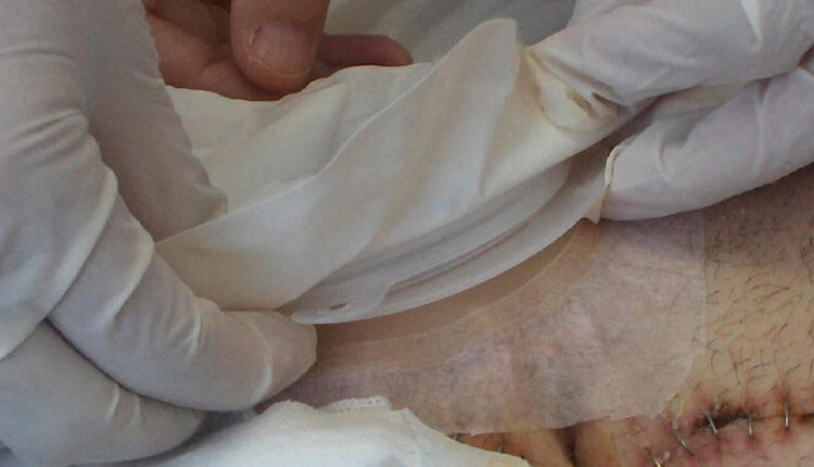 Adaptöre Uygun Stoma torbası