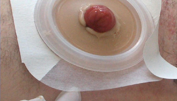 Stoma, Cilde Yapıştırma