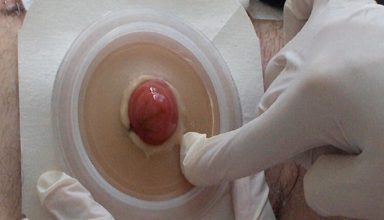 Stoma Cilde Yerleştirme