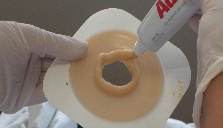 Stoma Pasta