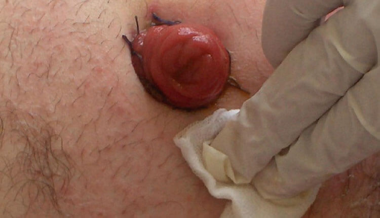 Stoma Silme İşlemi